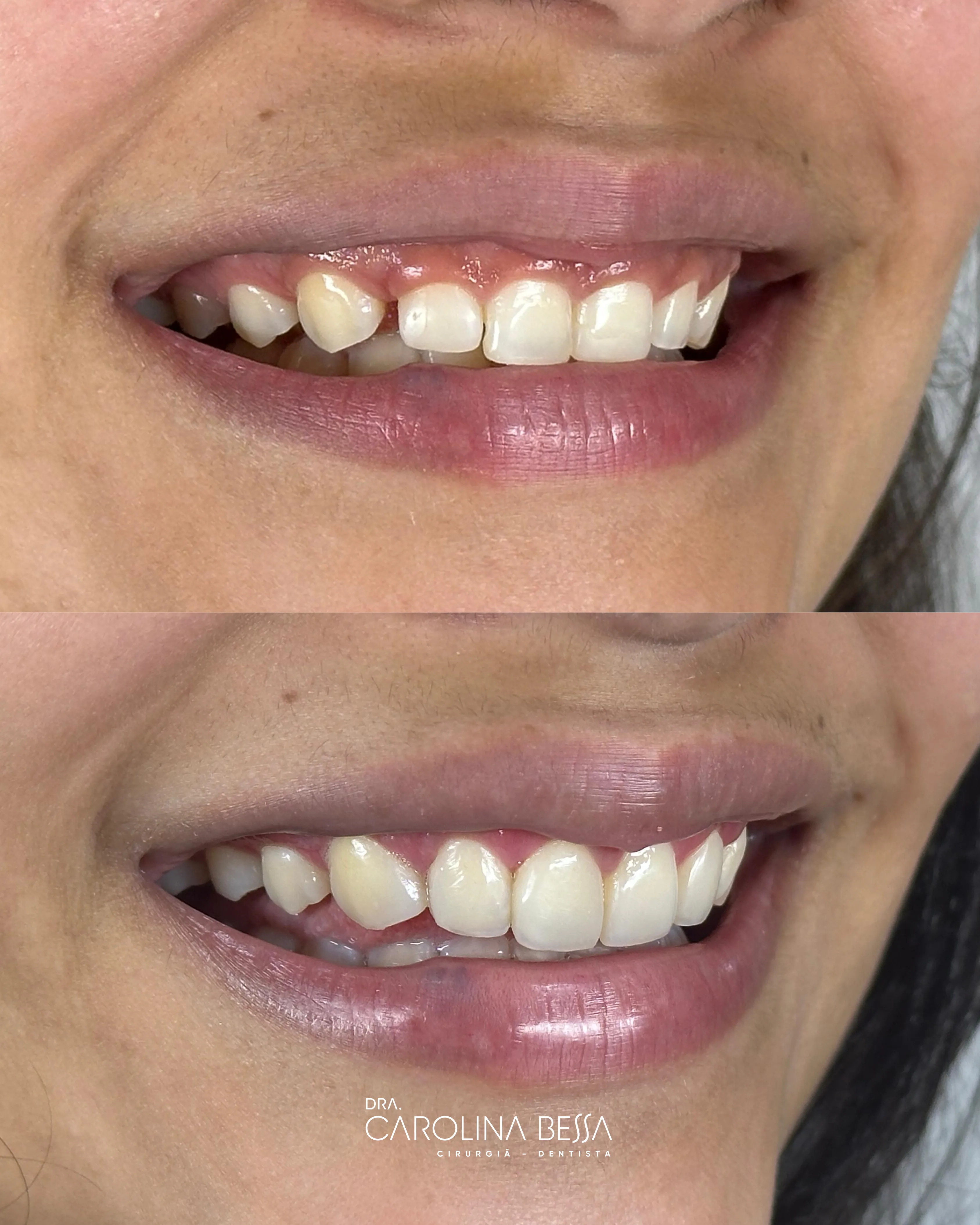 Antes e depois de tratamento odontológico — Gengivoplastia e reanatomização
