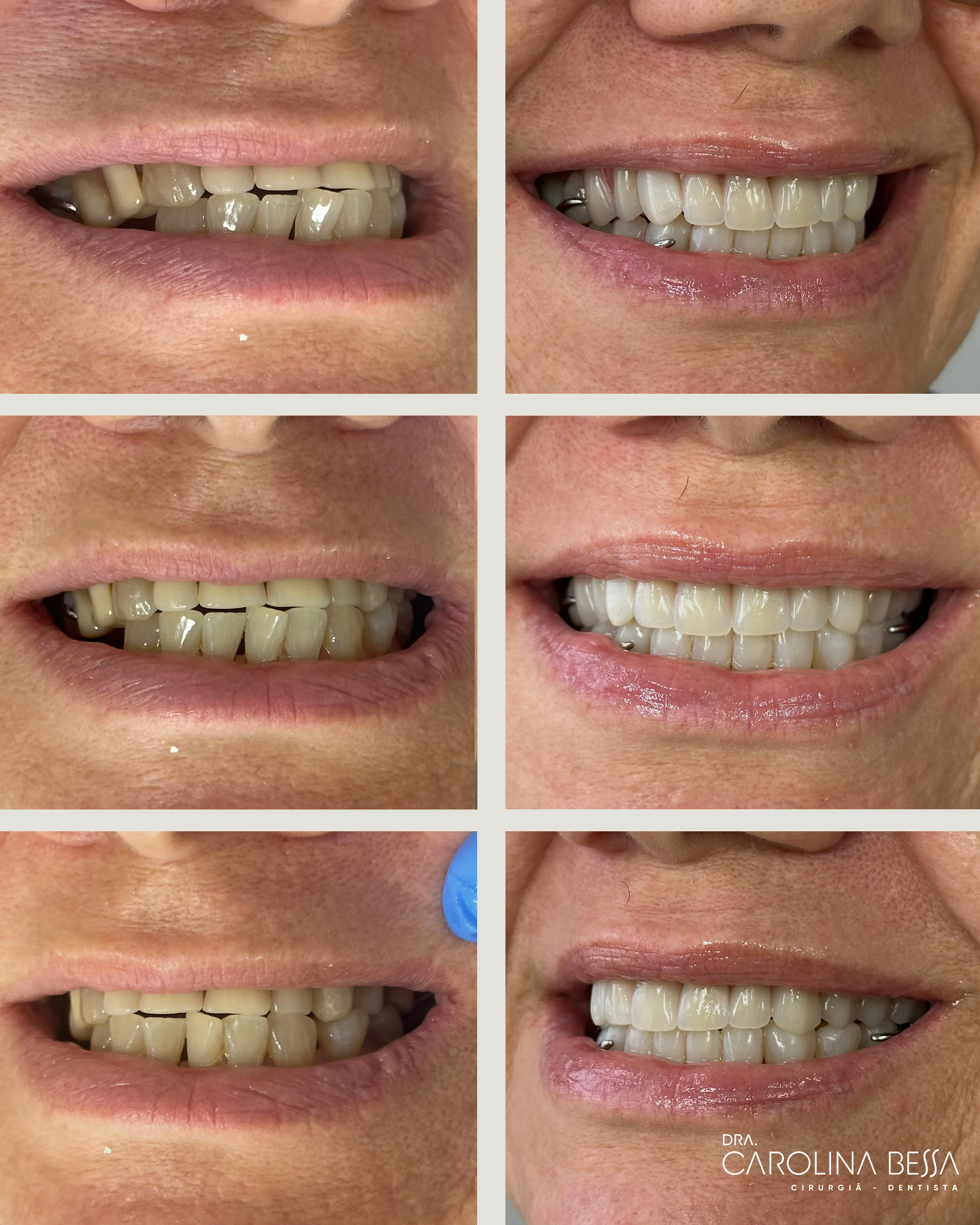 Antes e depois de tratamento odontológico — Queixa inicial: mastigação e estética comprometidas. Final: devolvendo confiança para sorrir