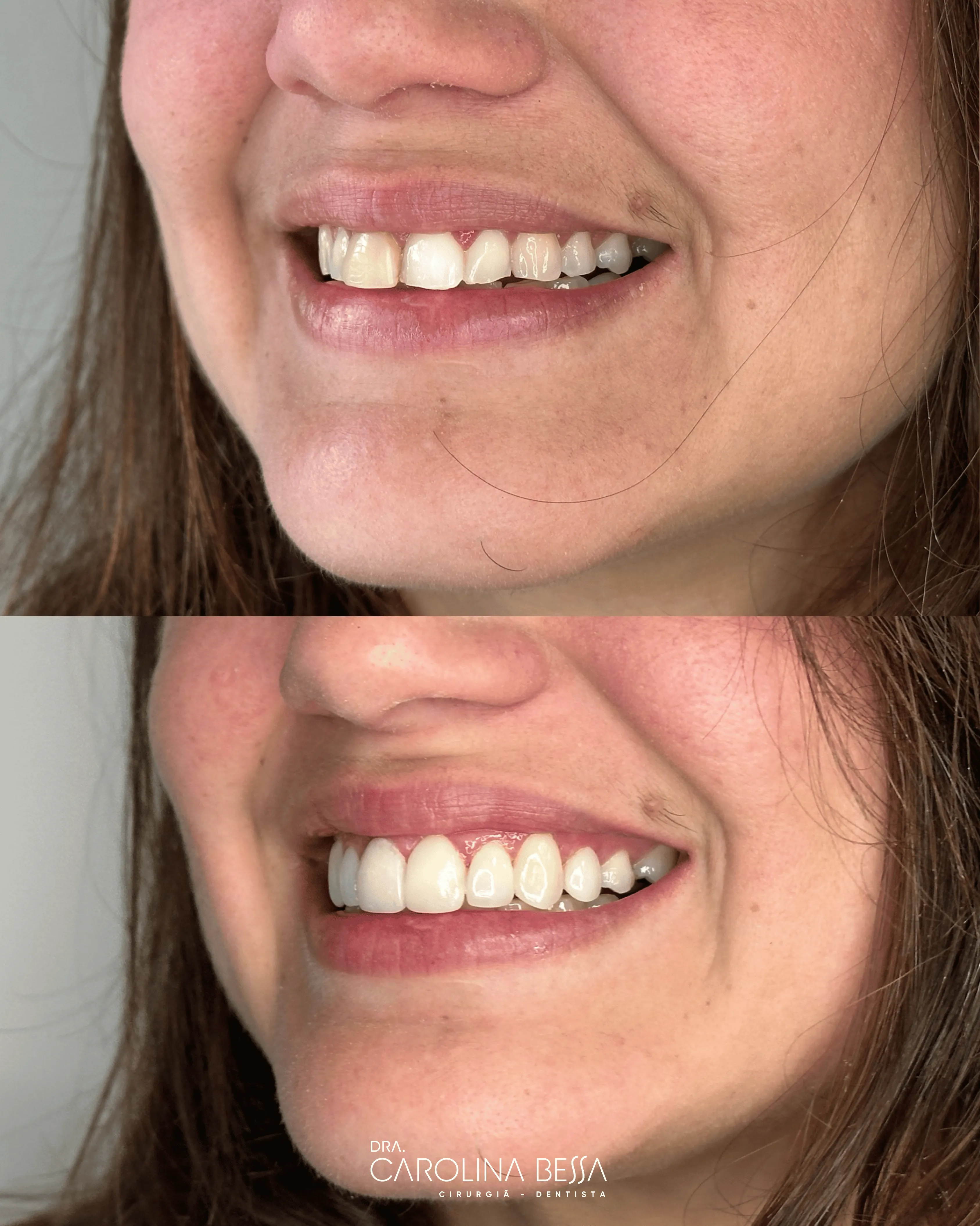 Antes e depois de tratamento odontológico — Proporção, alinhamento e ajuste de cor