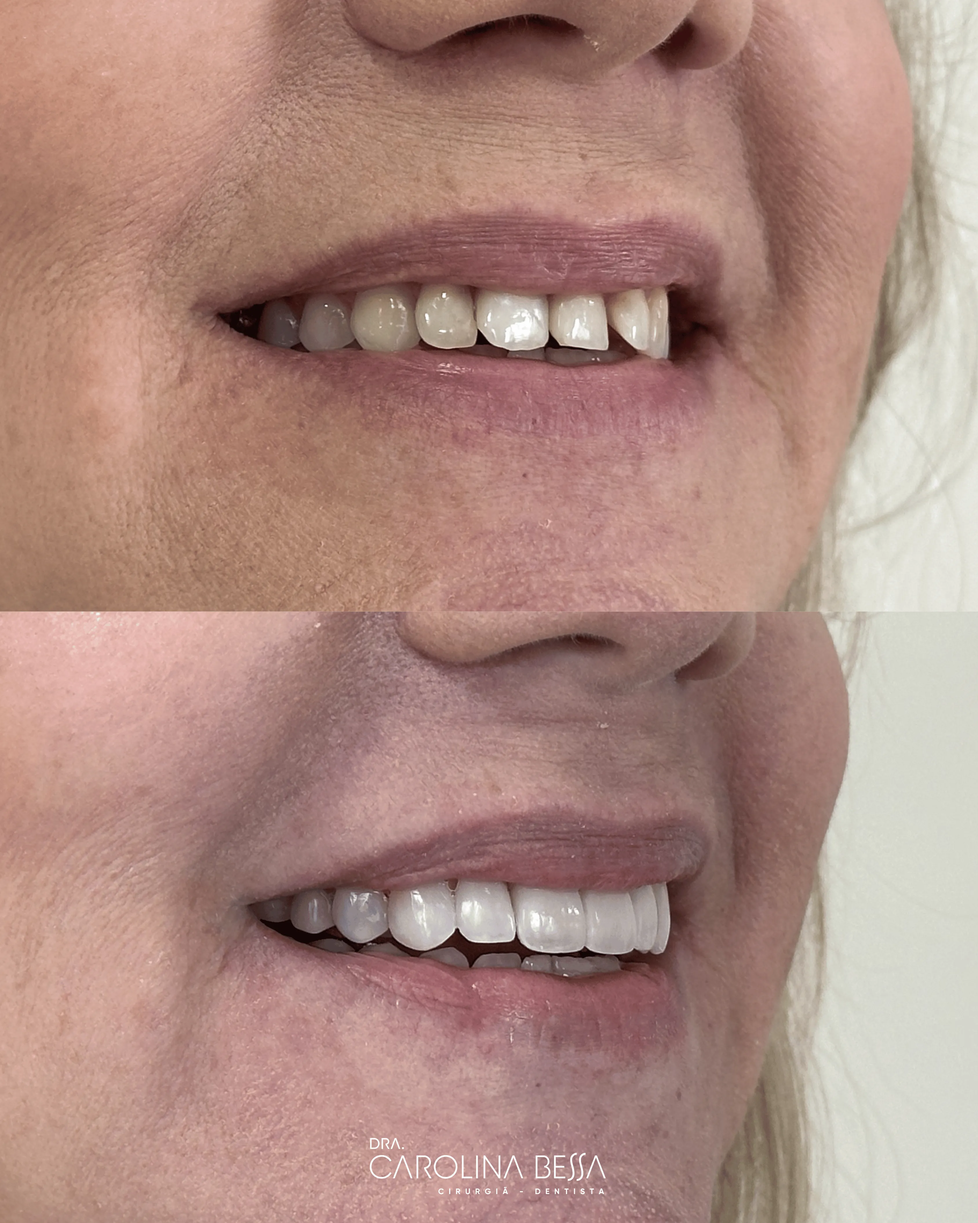 Antes e depois de tratamento odontológico — Proporção e alinhamento