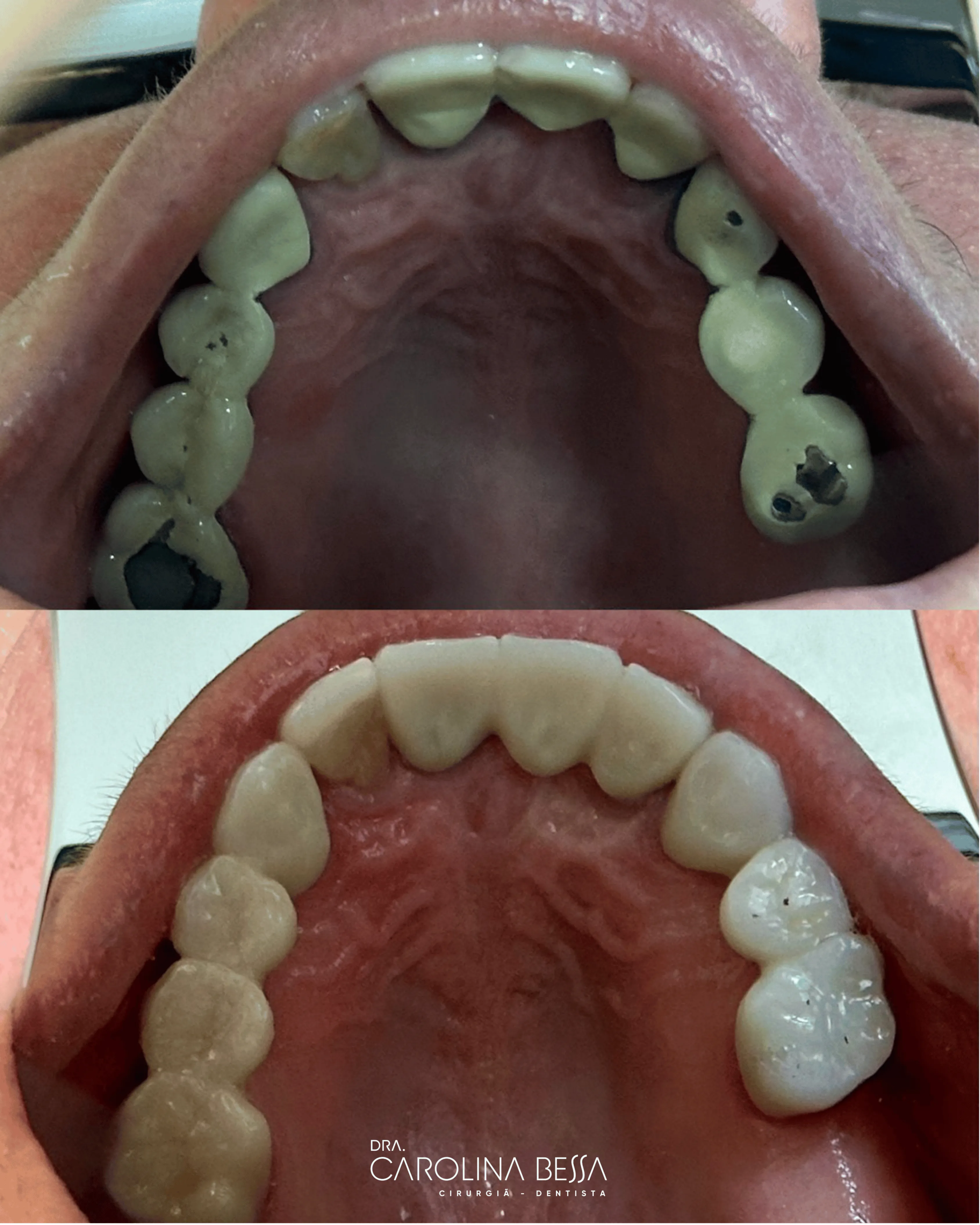 Antes e depois de tratamento odontológico — Queixa inicial: dificuldade de mastigação. Aspecto final: melhora estética e funcional