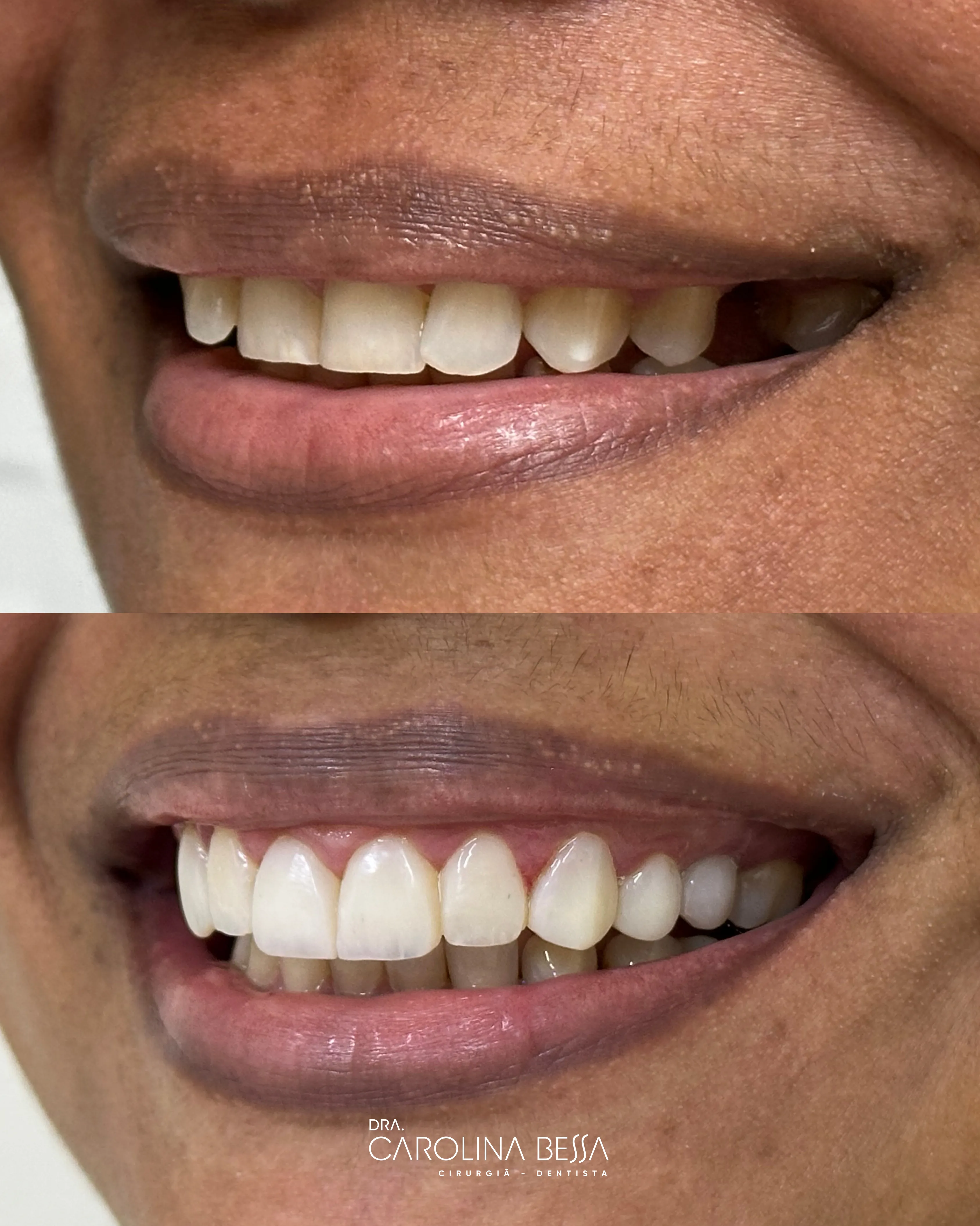 Antes e depois de tratamento odontológico — Alinhamento e coroa adesiva
