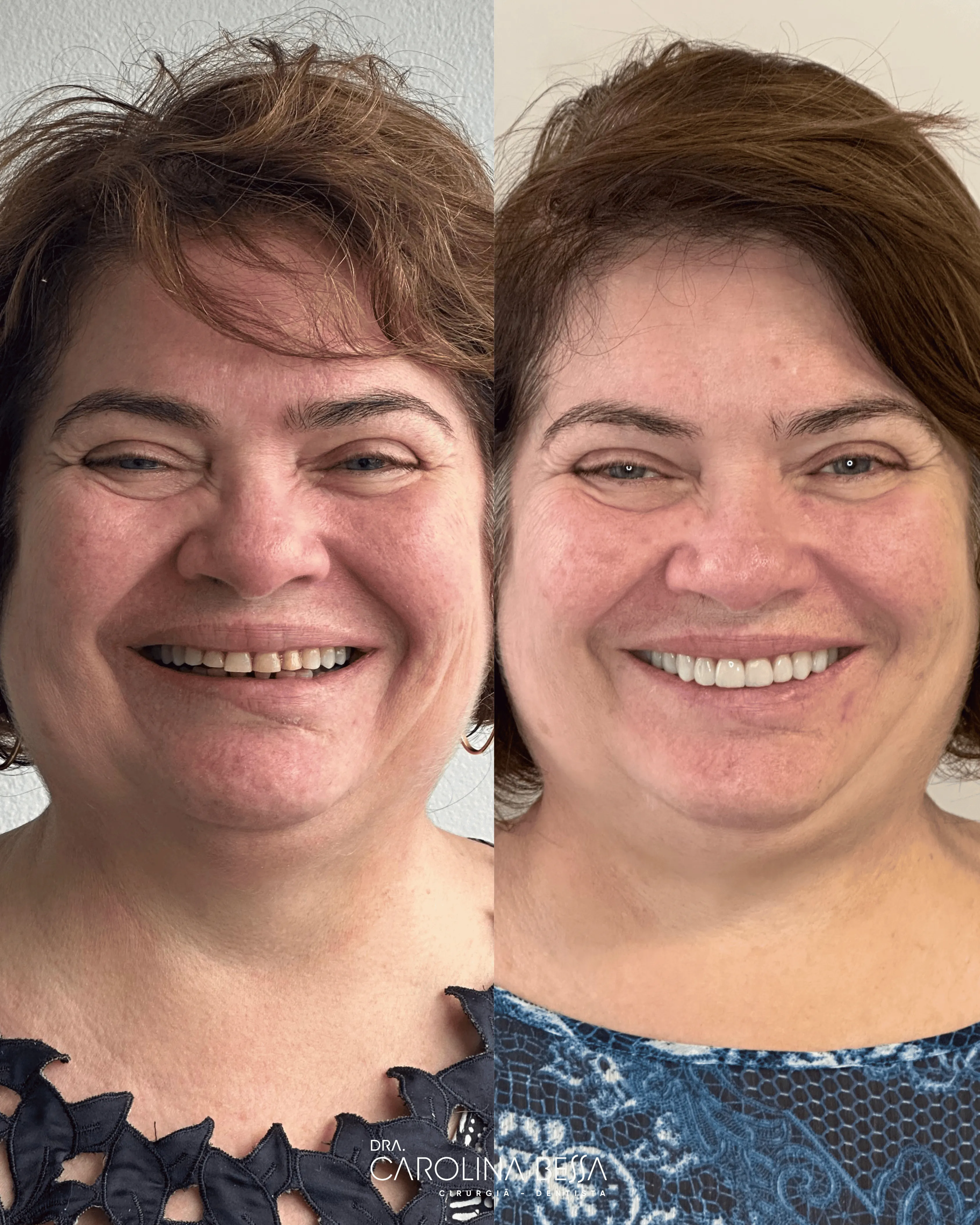 Antes e depois de tratamento odontológico — Alteração de forma e cor com laminados cerâmicos