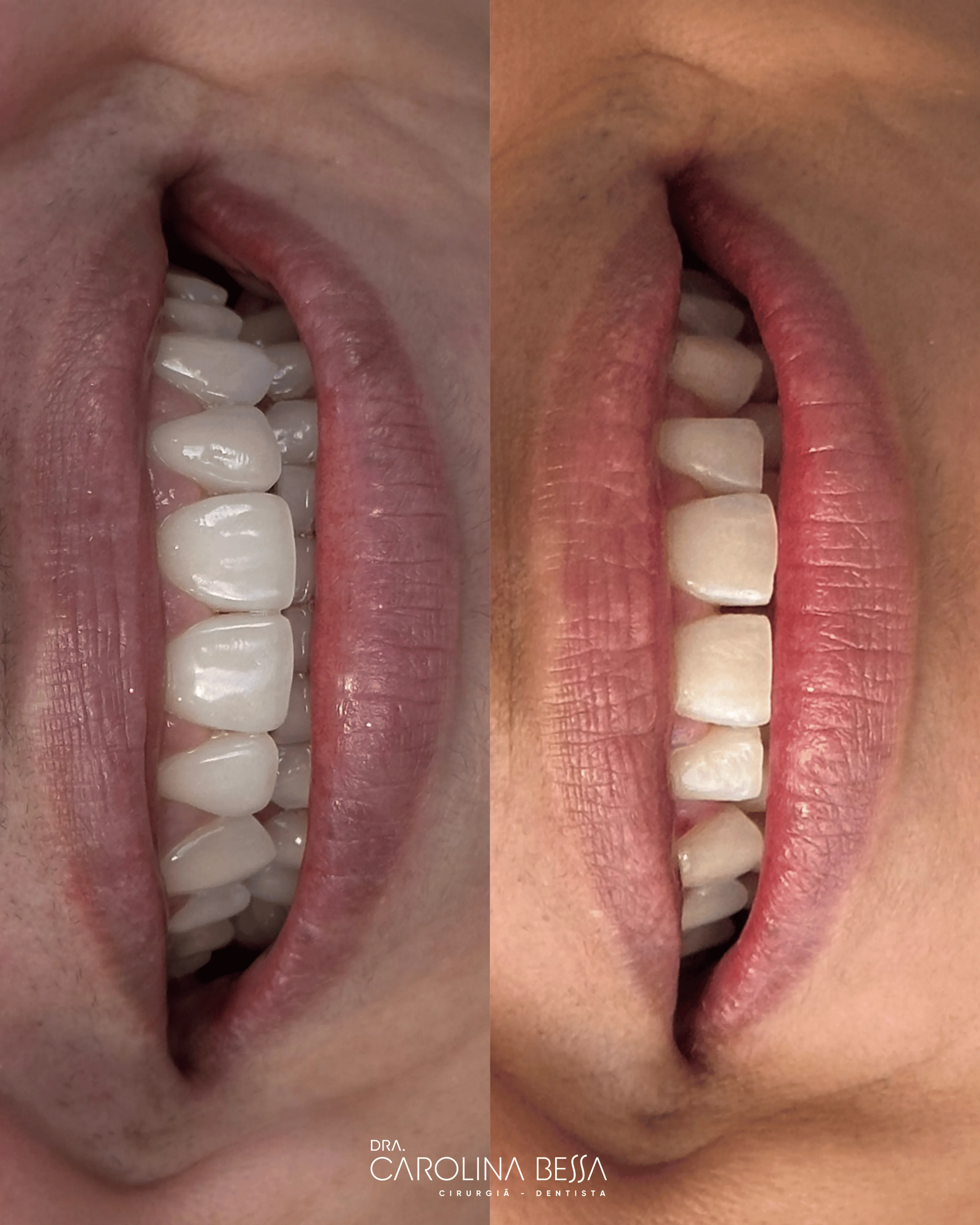 Antes e depois de tratamento estético dental — caso 3