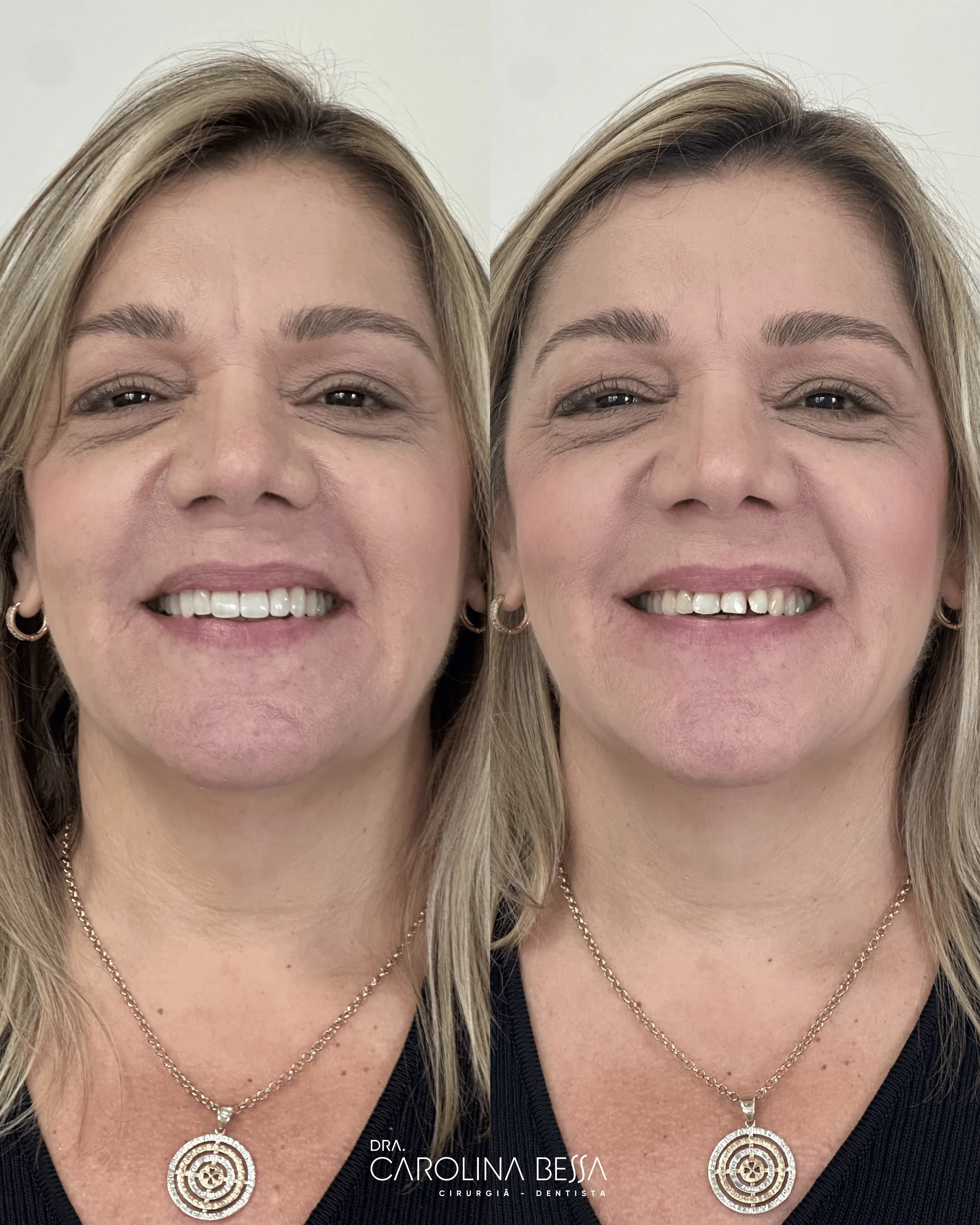 Antes e depois de tratamento estético dental — caso 2