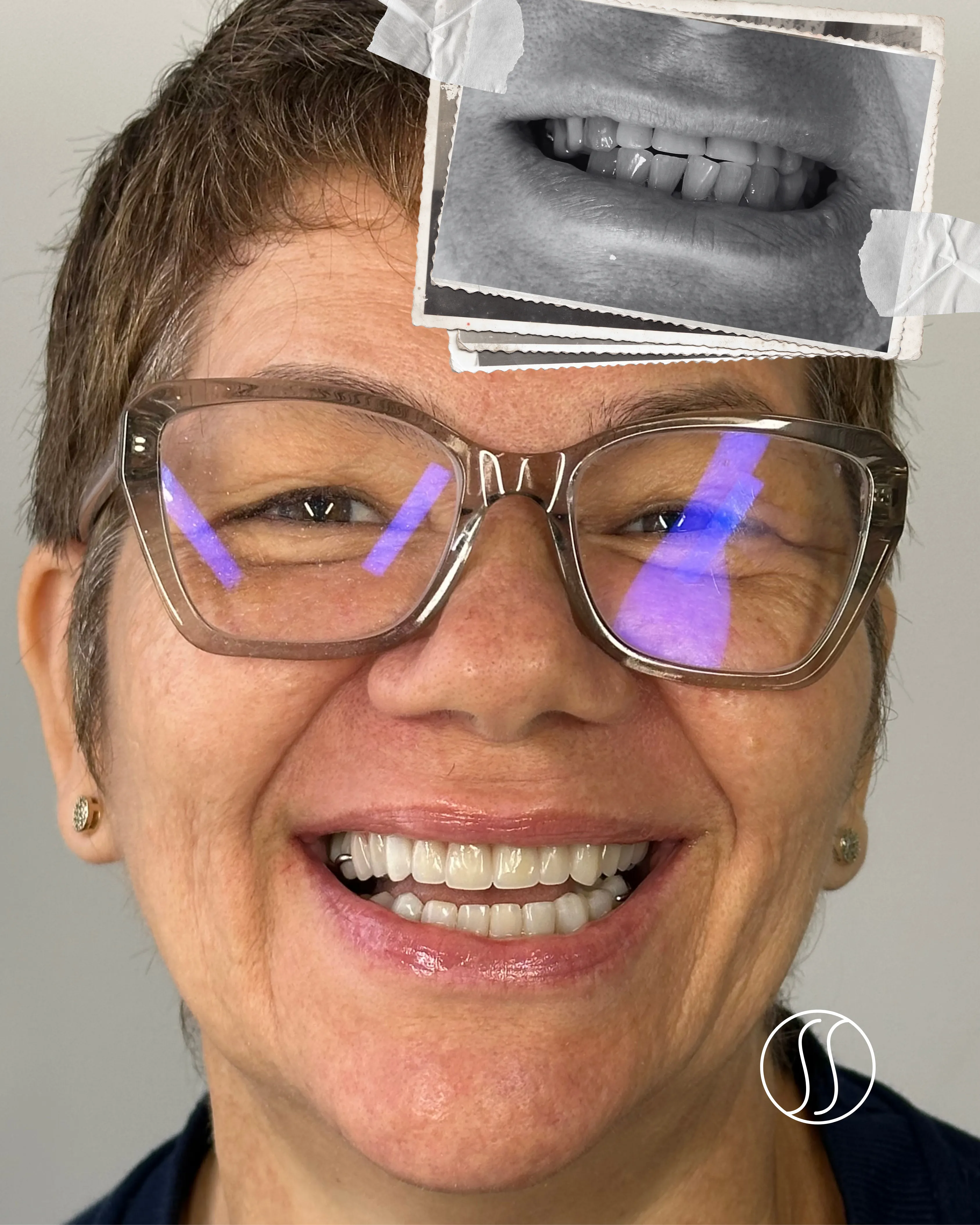 Antes e depois de tratamento de reabilitação oral — caso 1