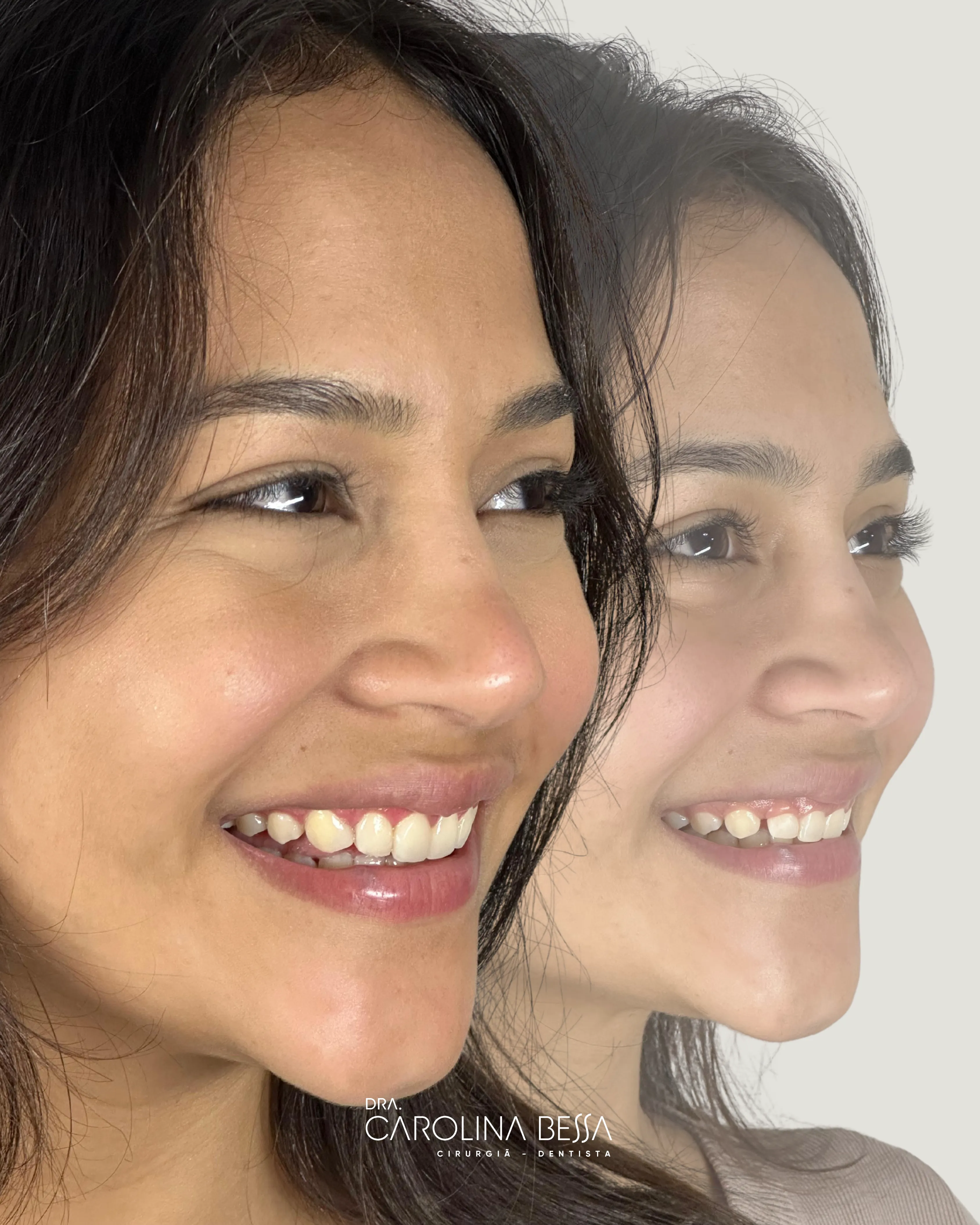 Antes e depois de tratamento odontológico — Queixa inicial: sorriso infantil