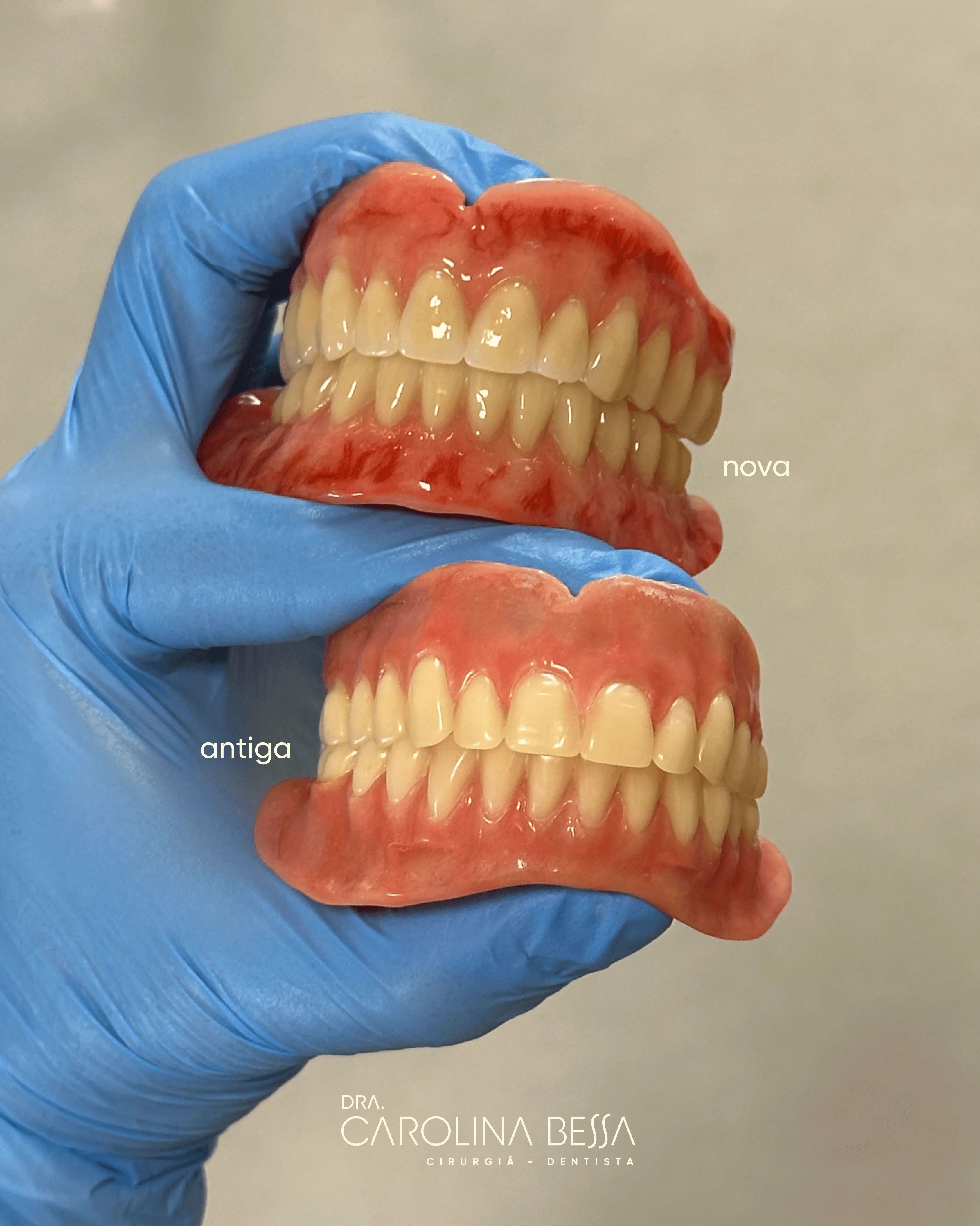 Antes e depois de tratamento de reabilitação oral — caso 2