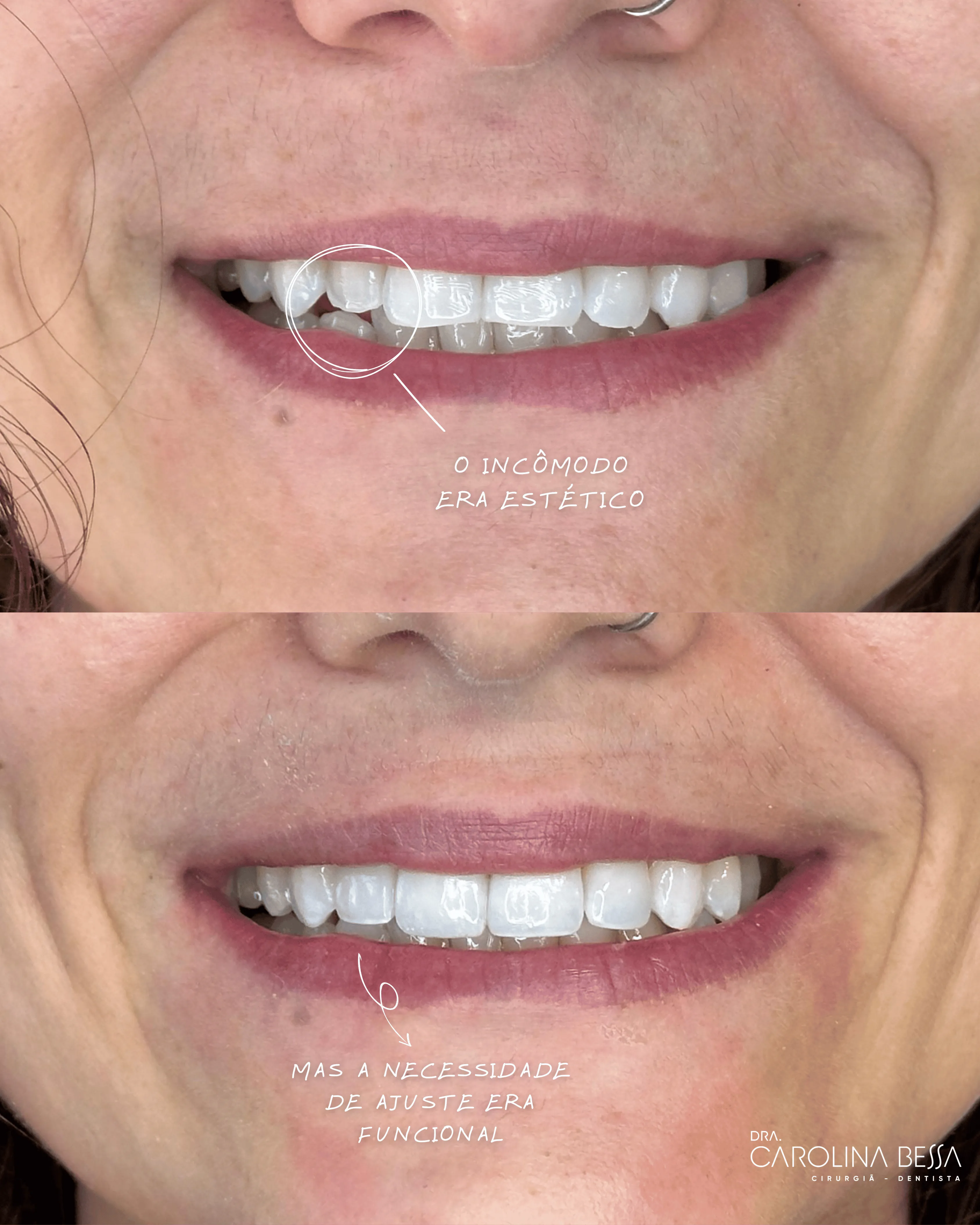 Antes e depois de tratamento odontológico — Ajuste estético e funcional