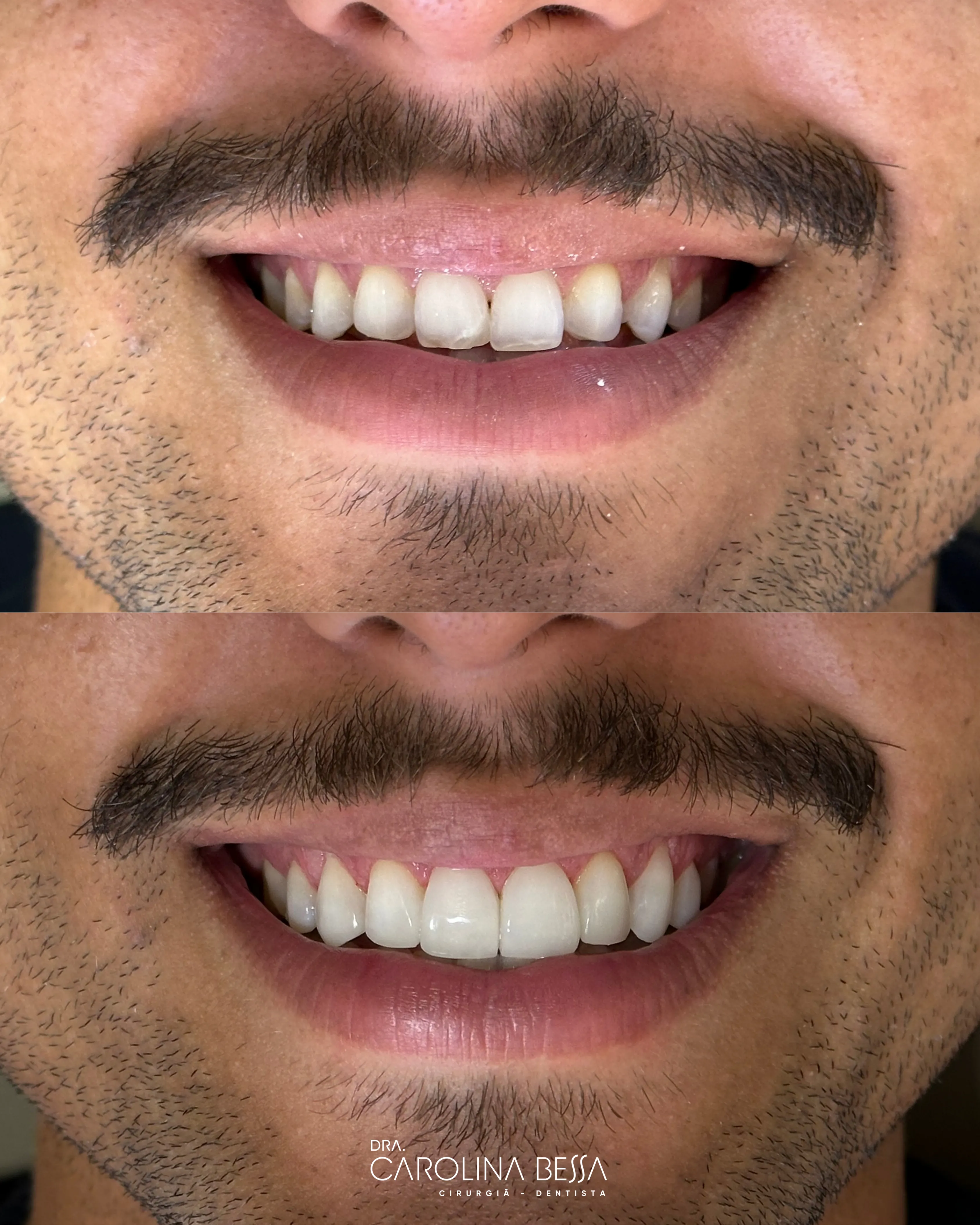 Antes e depois de tratamento odontológico — Alinhamento e reanatomização estética