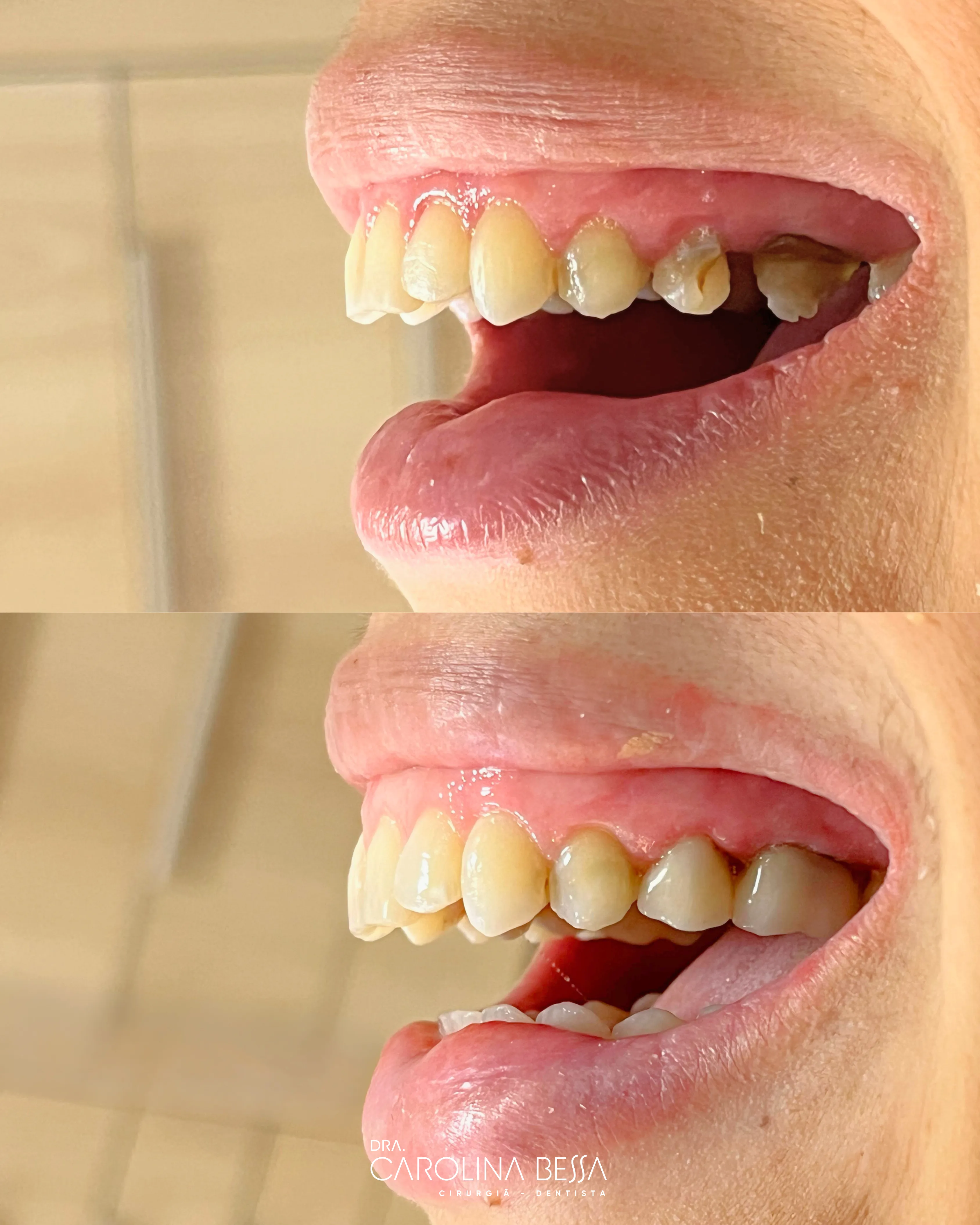 Antes e depois de tratamento odontológico — Devolvendo segurança para sorrir com coroas em zircônia