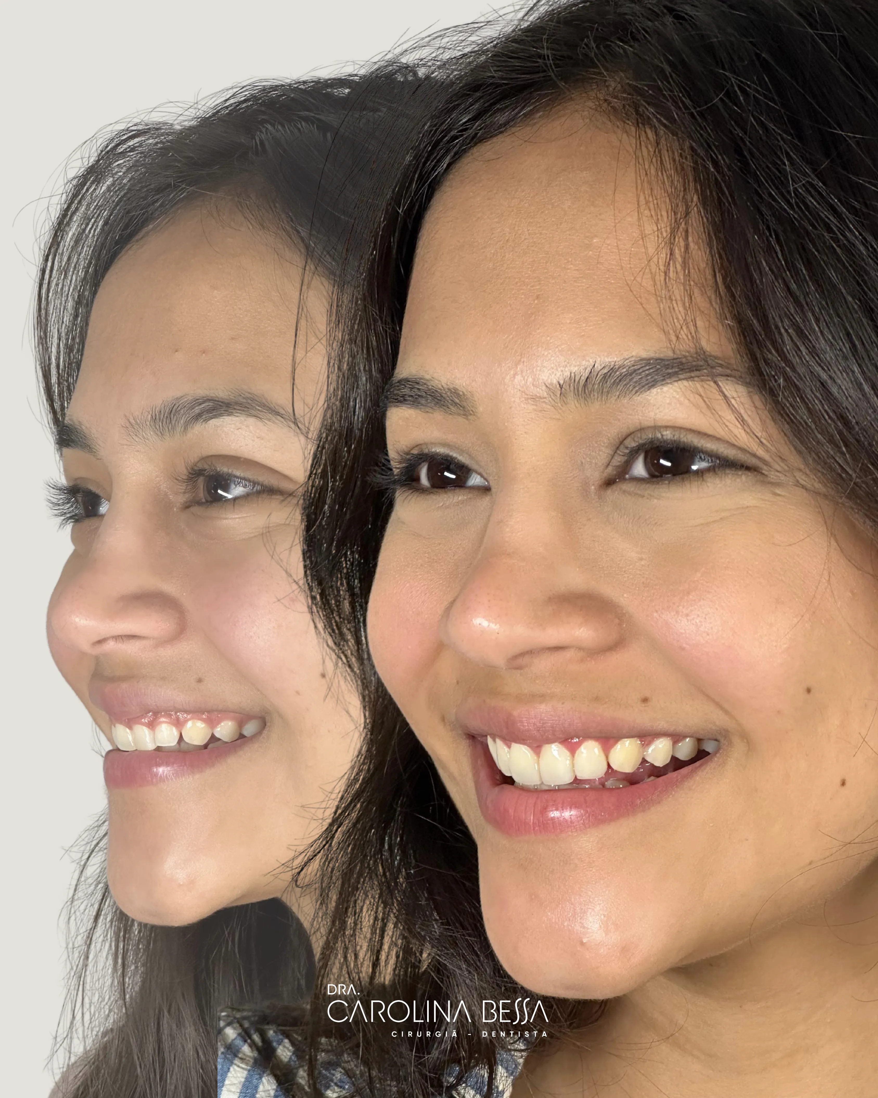 Antes e depois de tratamento estético dental — caso 1
