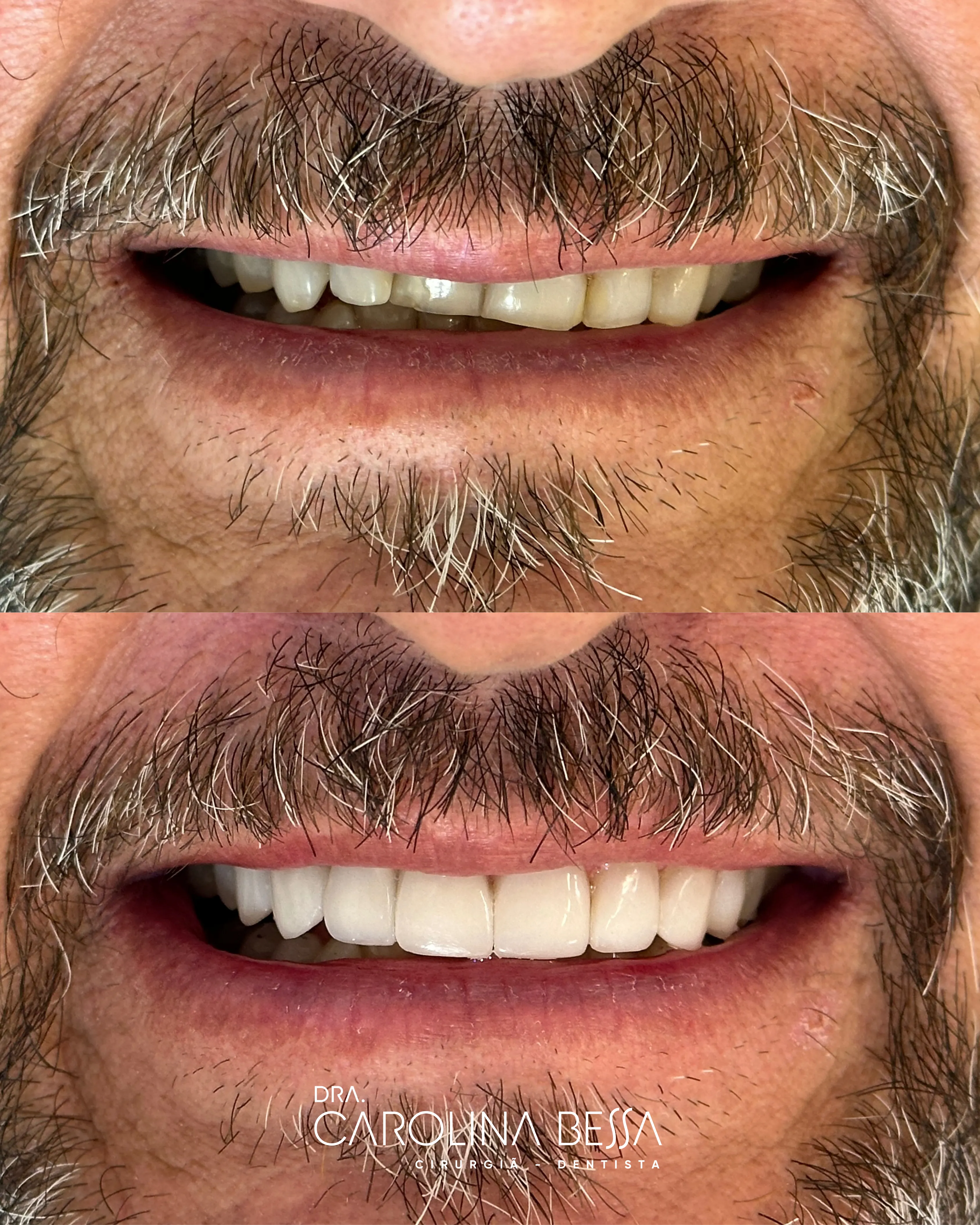 Antes e depois de tratamento odontológico — Queixa inicial: dentes não apareciam ao sorrir. Aspecto final: dentes mais alongados, iluminados e alinhados (rejuvenescimento do sorriso)