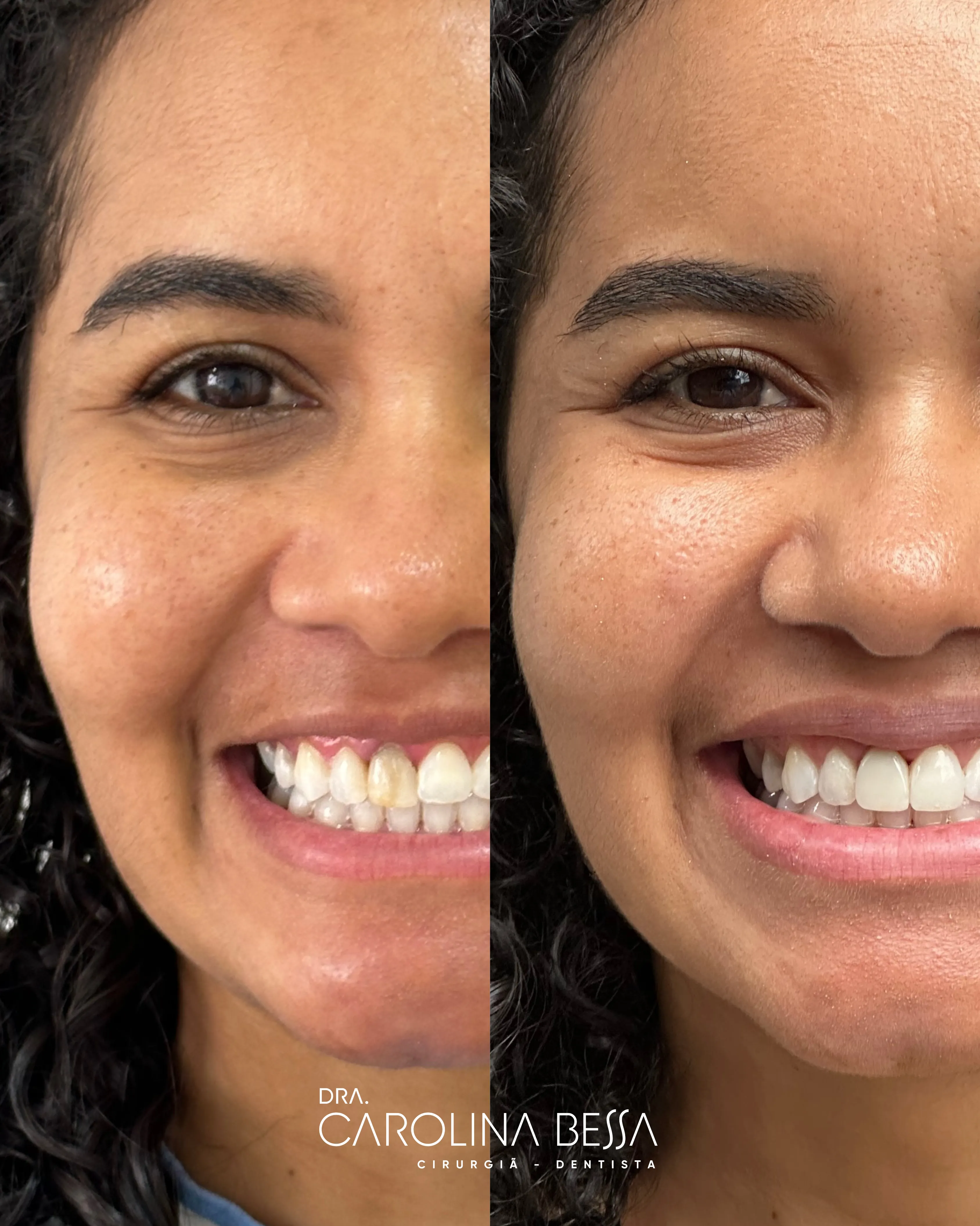 Antes e depois de tratamento estético dental — caso 4