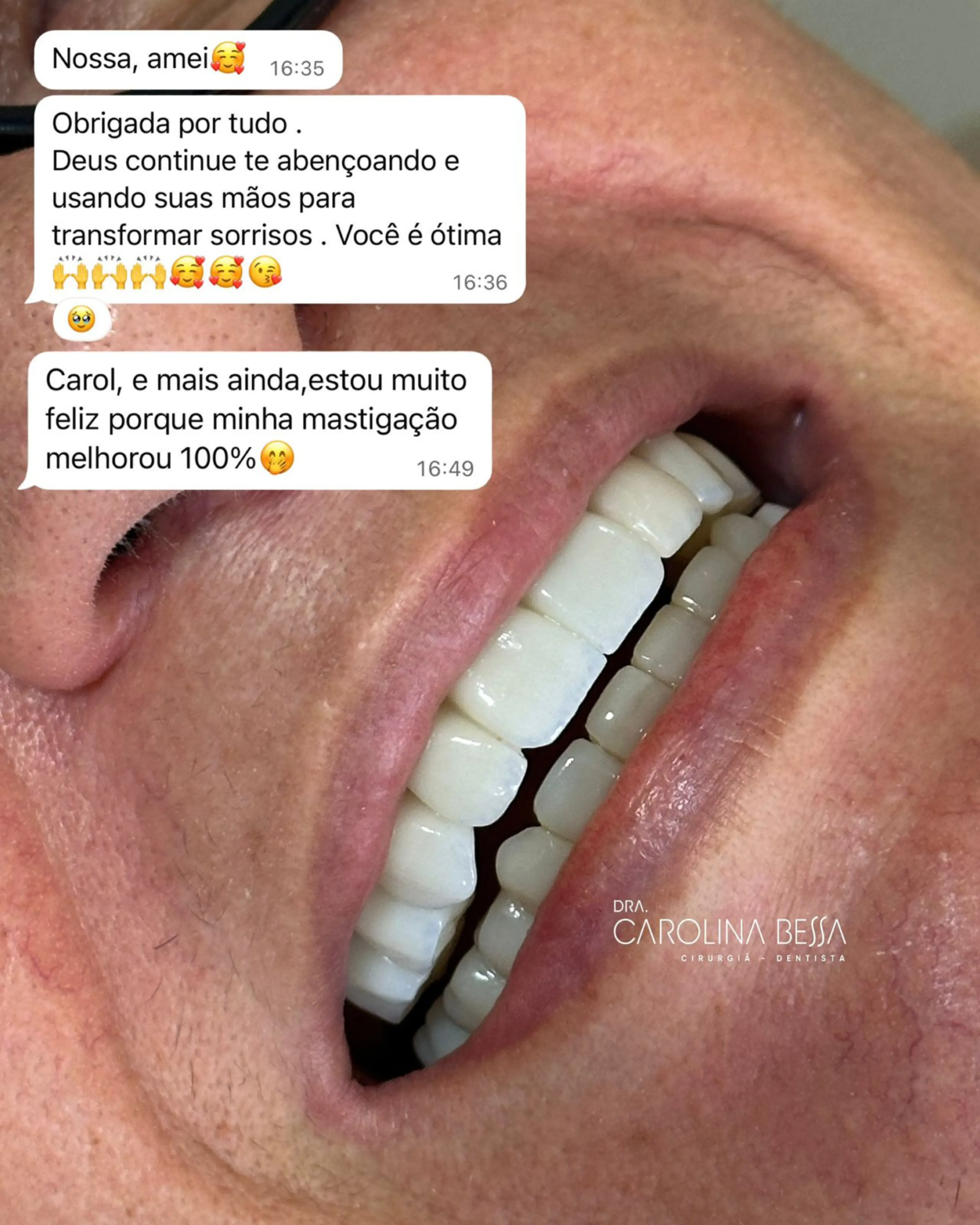 Antes e depois de tratamento de reabilitação oral — caso 3