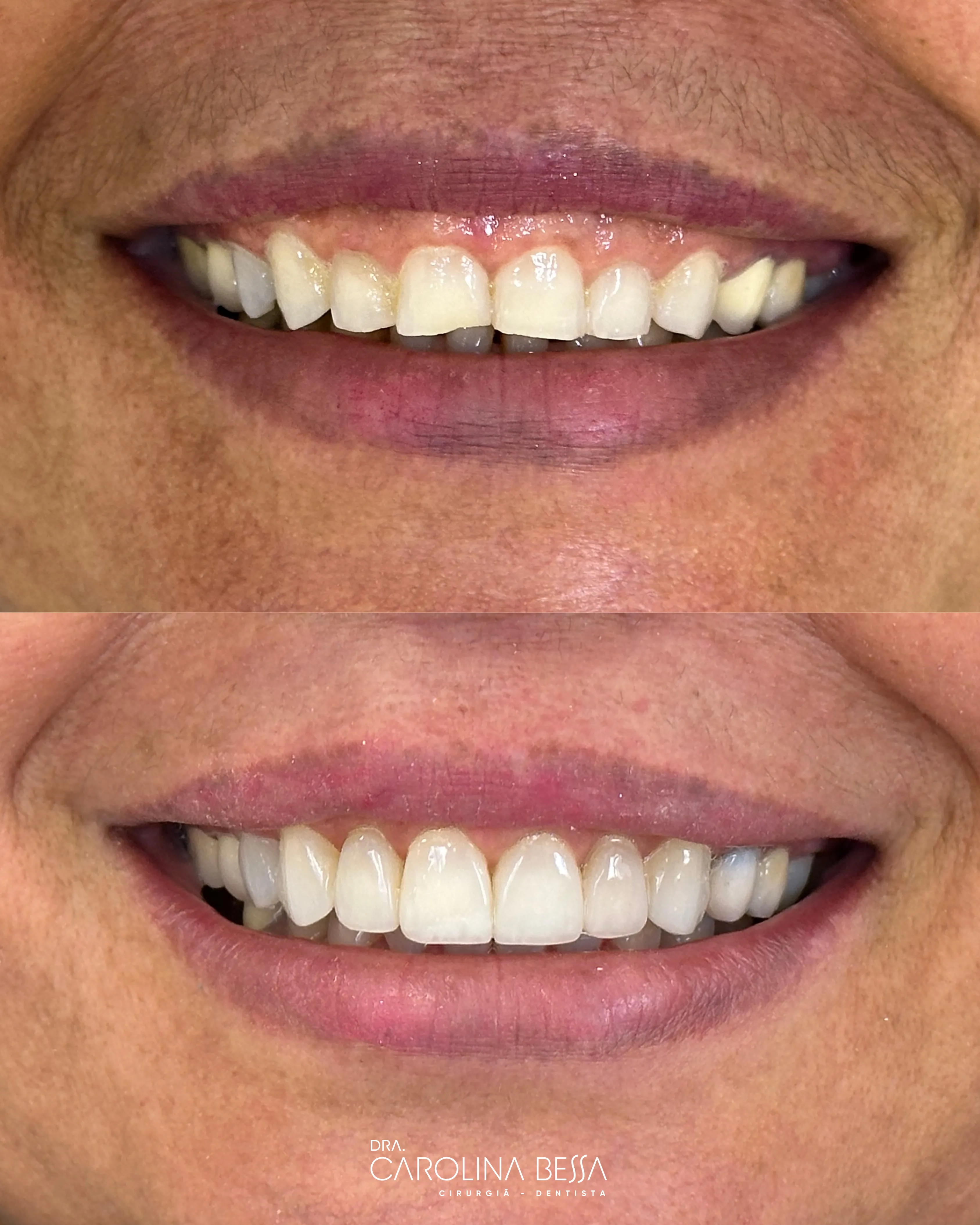 Antes e depois de tratamento odontológico — Gengivoplastia e reanatomização