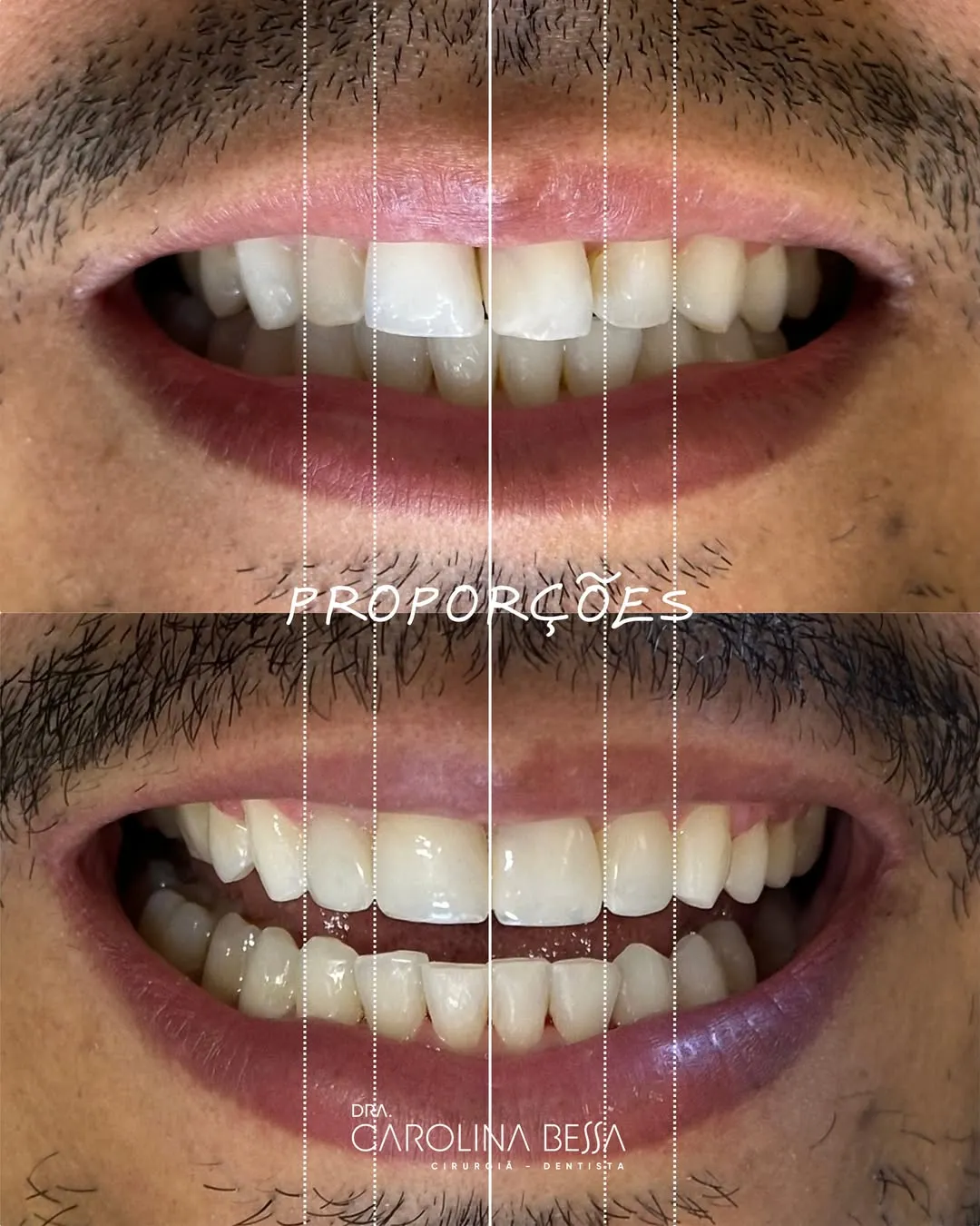 Antes e depois de tratamento odontológico — Reanatomização para harmonia das proporções dentárias