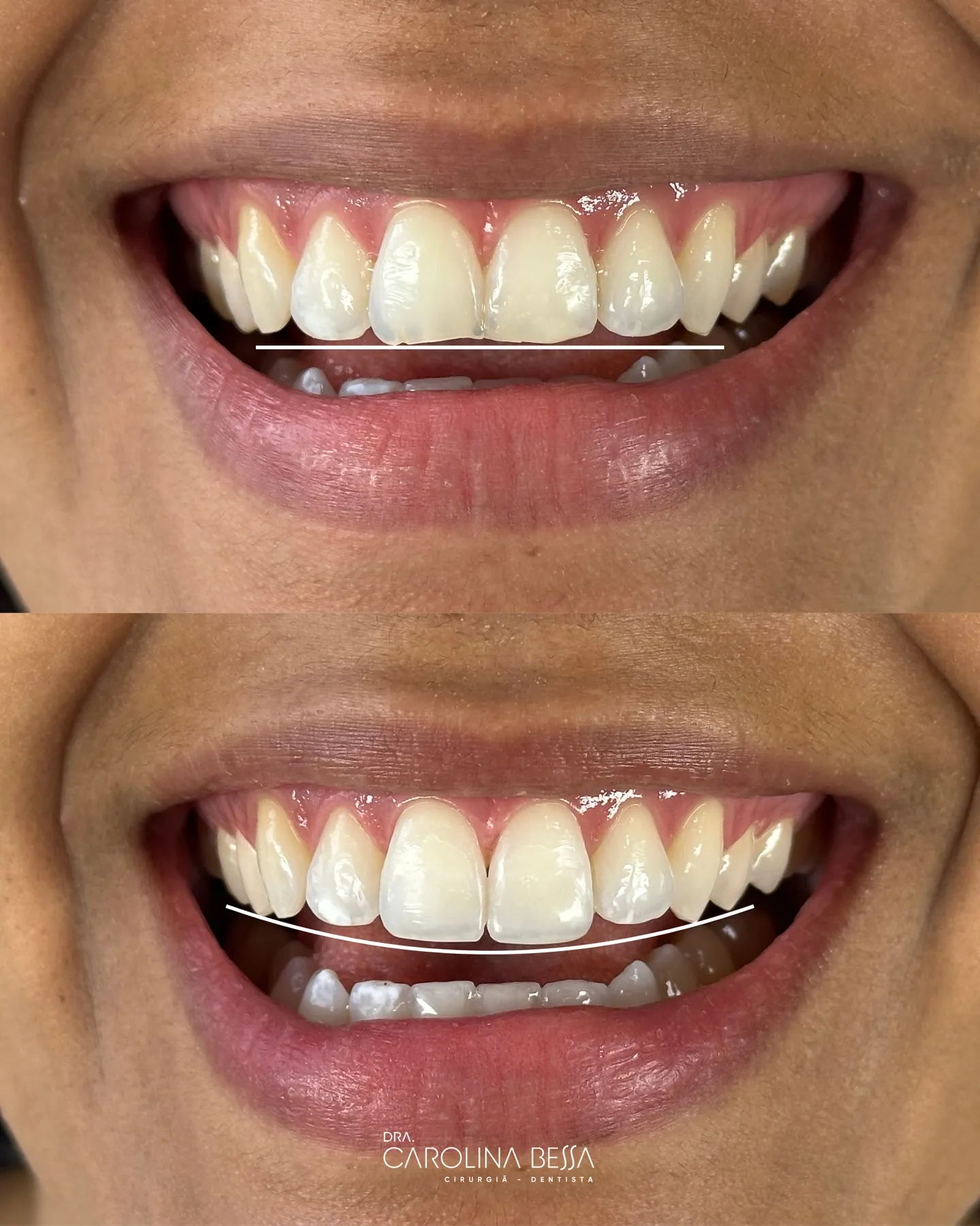Antes e depois de tratamento odontológico — Correção da linha do sorriso com laminados cerâmicos
