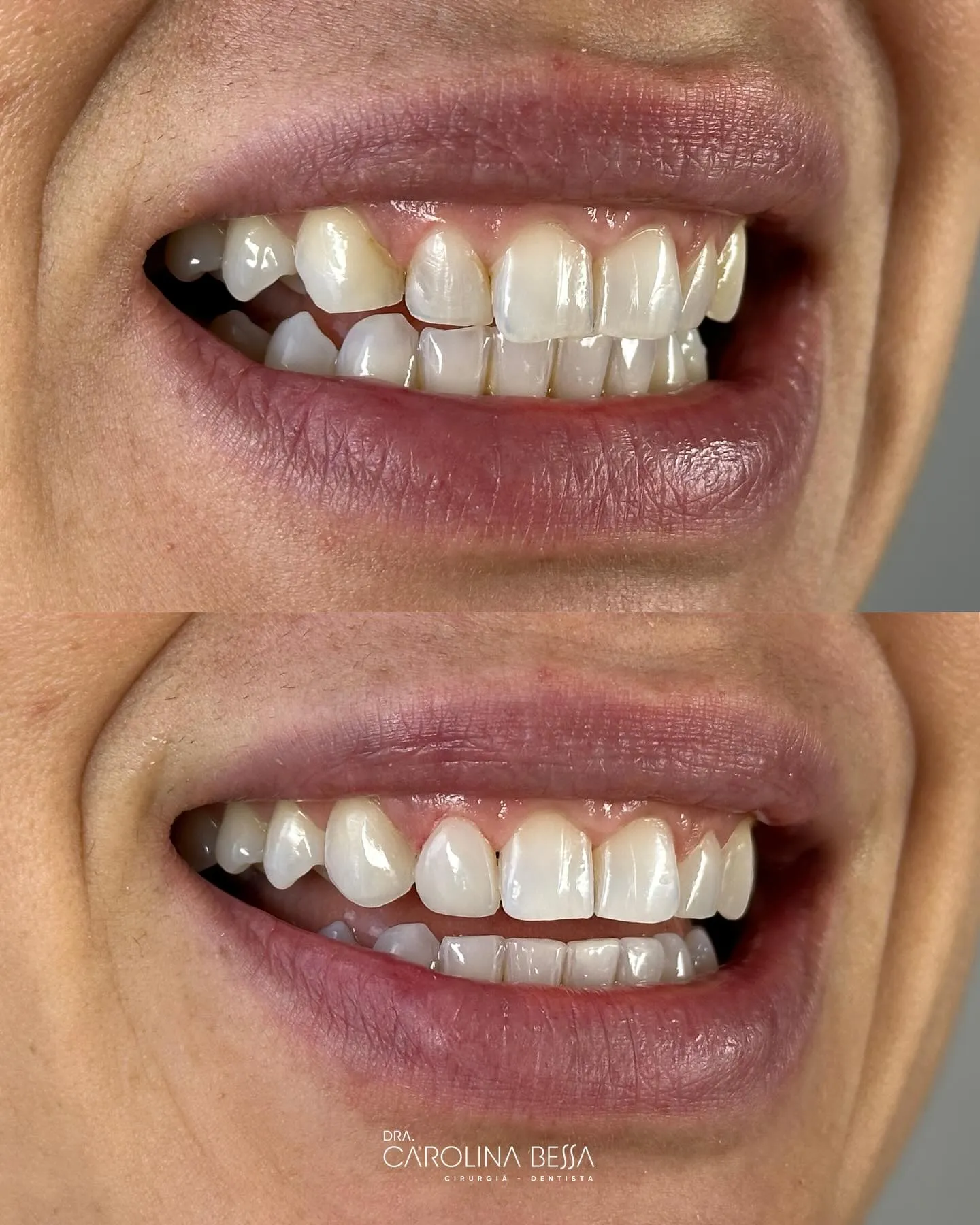 Antes e depois de tratamento odontológico — Uniformização de forma e cor com laminados cerâmicos